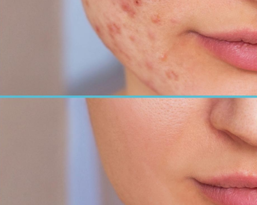 depilacion-laser-en-murcia-5